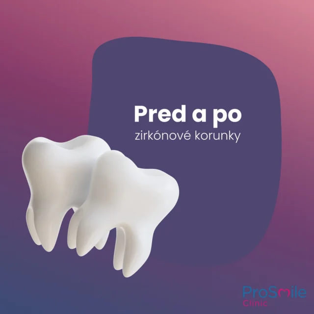 👉 Zirkónové korunky na horných jednotkách a dvojkách. Pacientka požadovala vysokú estetiku pri zmene tvaru a veľkosti zubov. 🦷